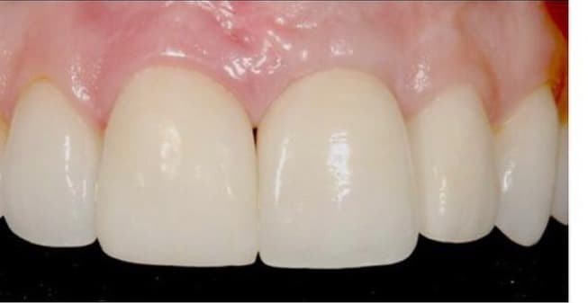 Dental implant before and after Beverly Hills