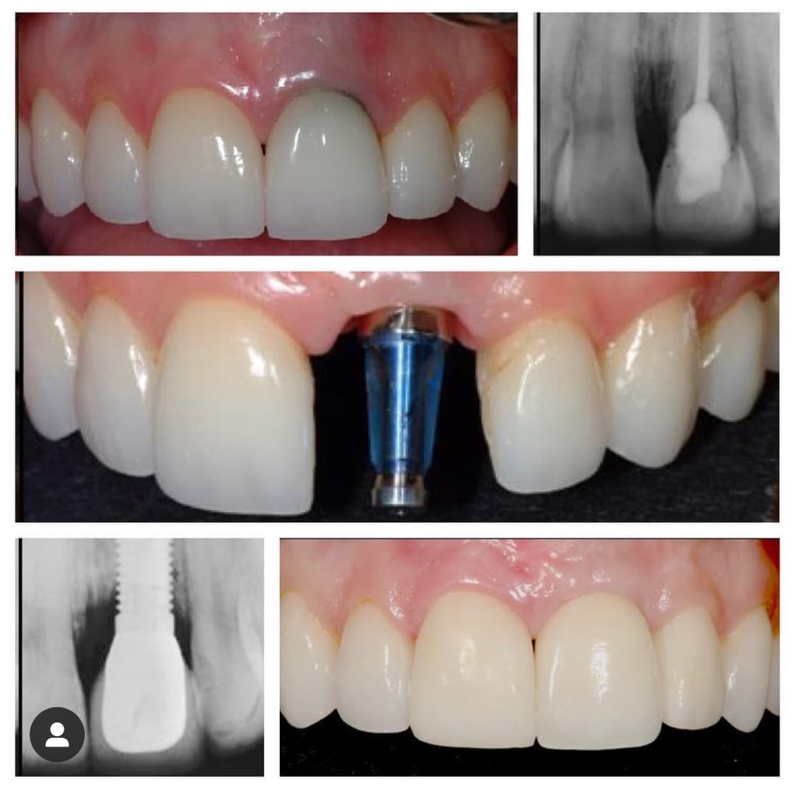 Dental implant before and after Beverly Hills