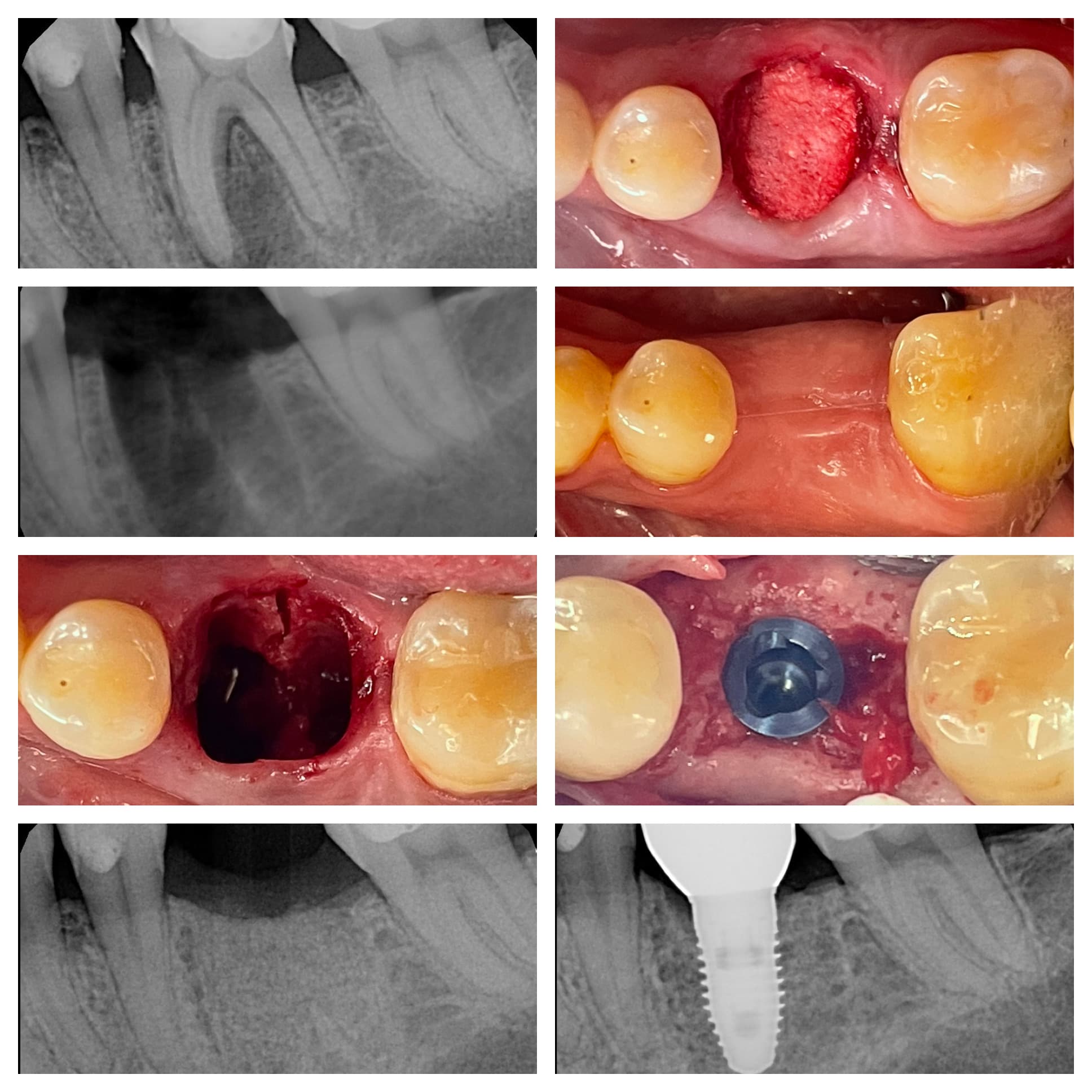 Dental implant result Beverly Hills periodontist