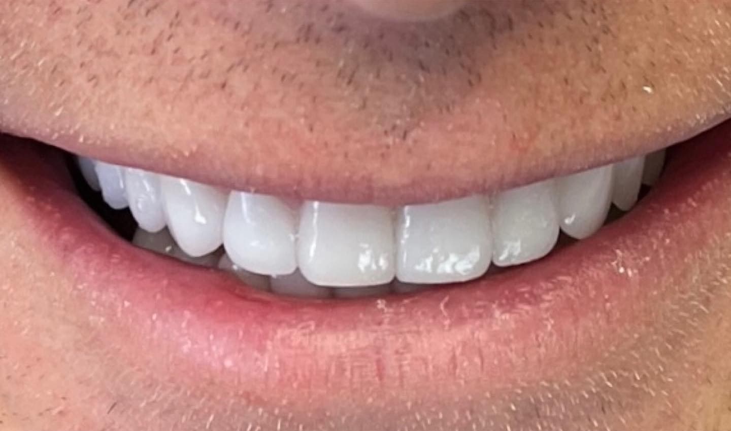 Periodontal treatment outcome from Dr. Baradaran Beverly Hills