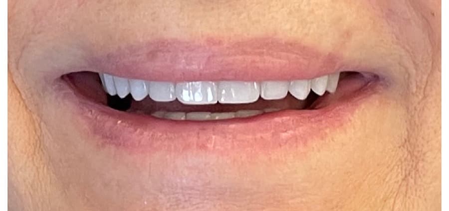 Smile transformation — Beverly Hills (after)