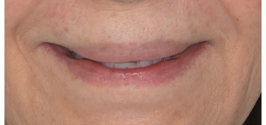 Smile transformation — Beverly Hills (before)