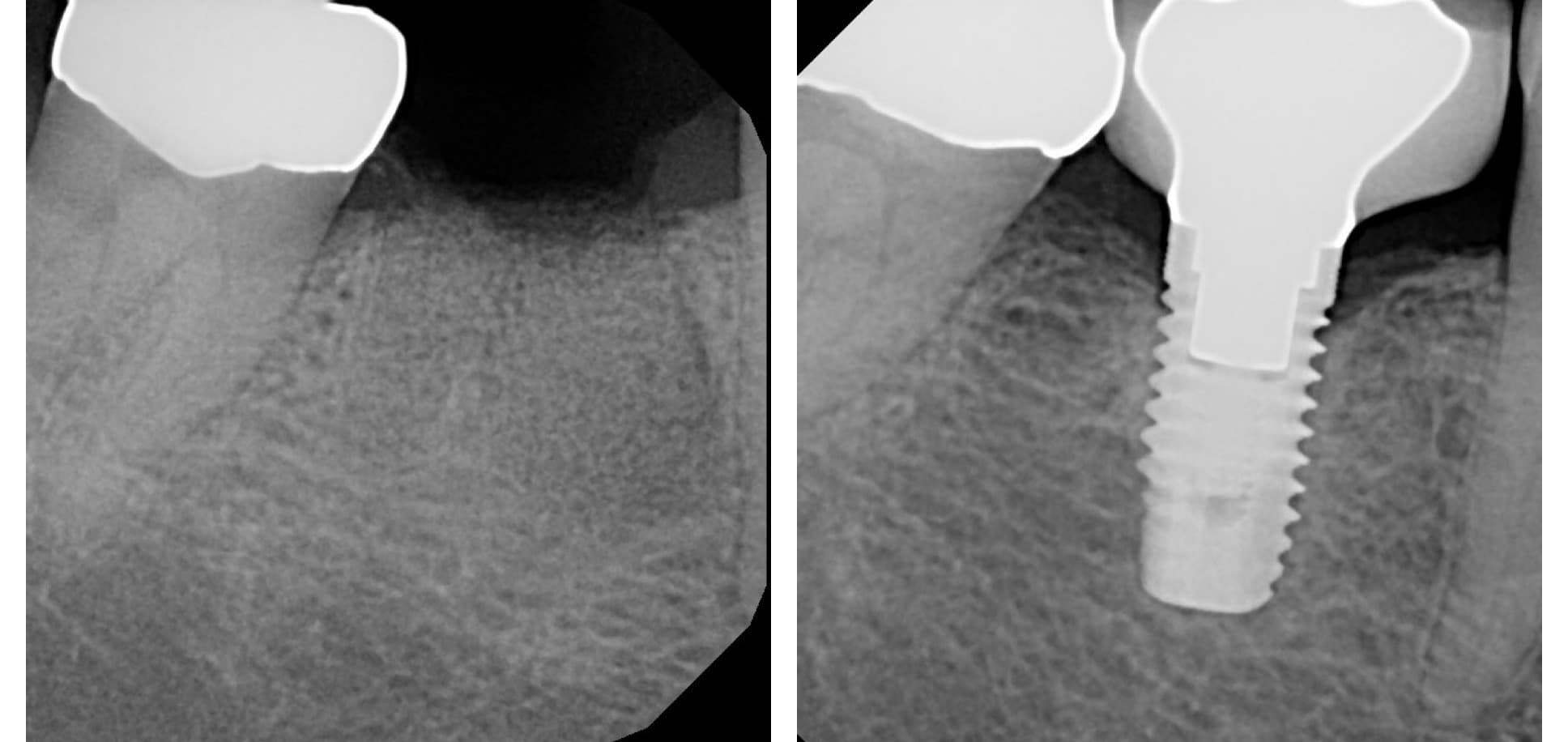 Implant X-rays (after)