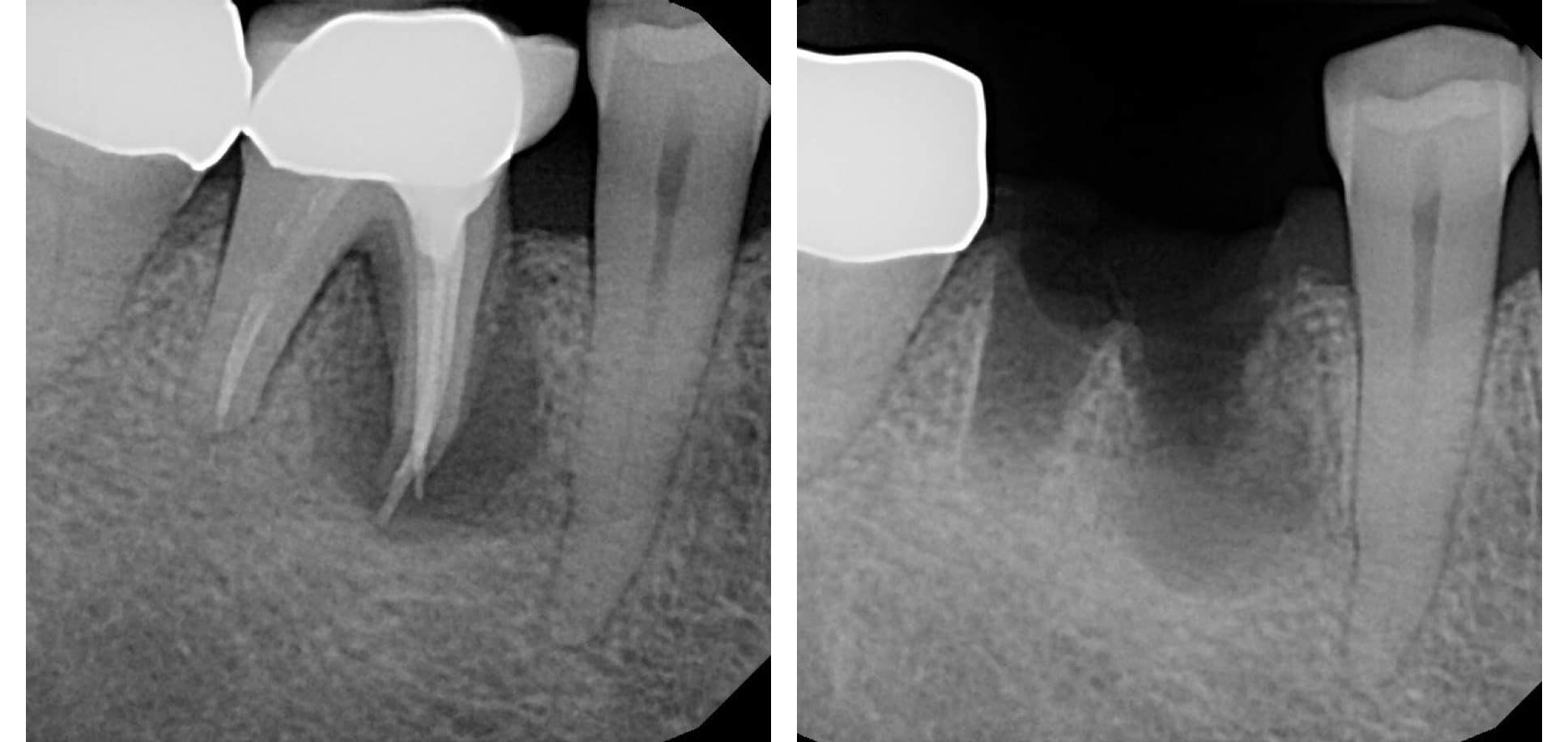 Implant X-rays (before)