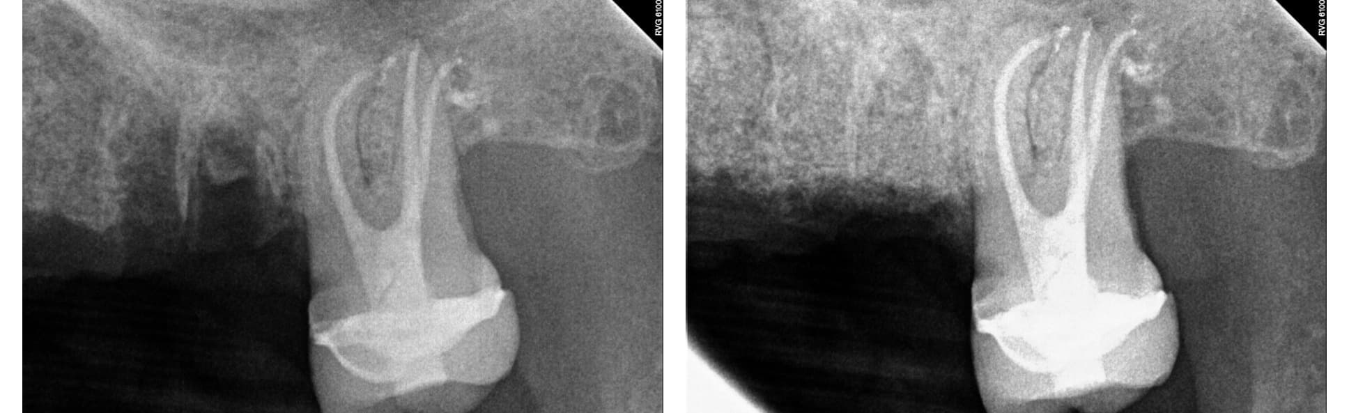Implant treatment (1 of 3)