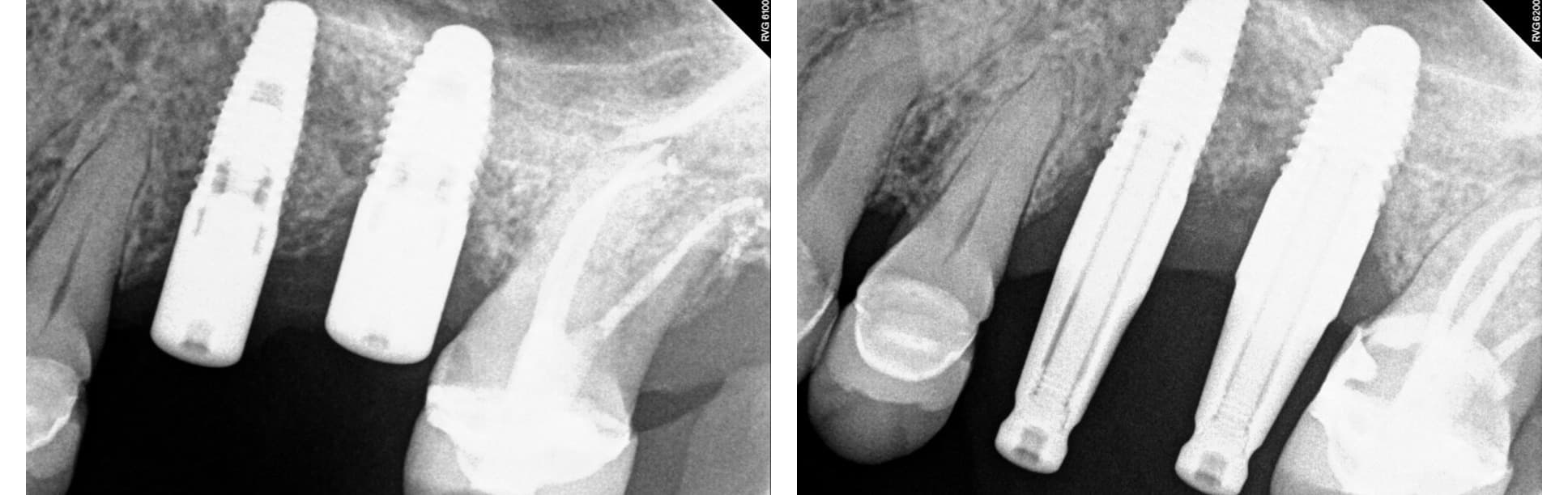 Implant treatment (2 of 3)
