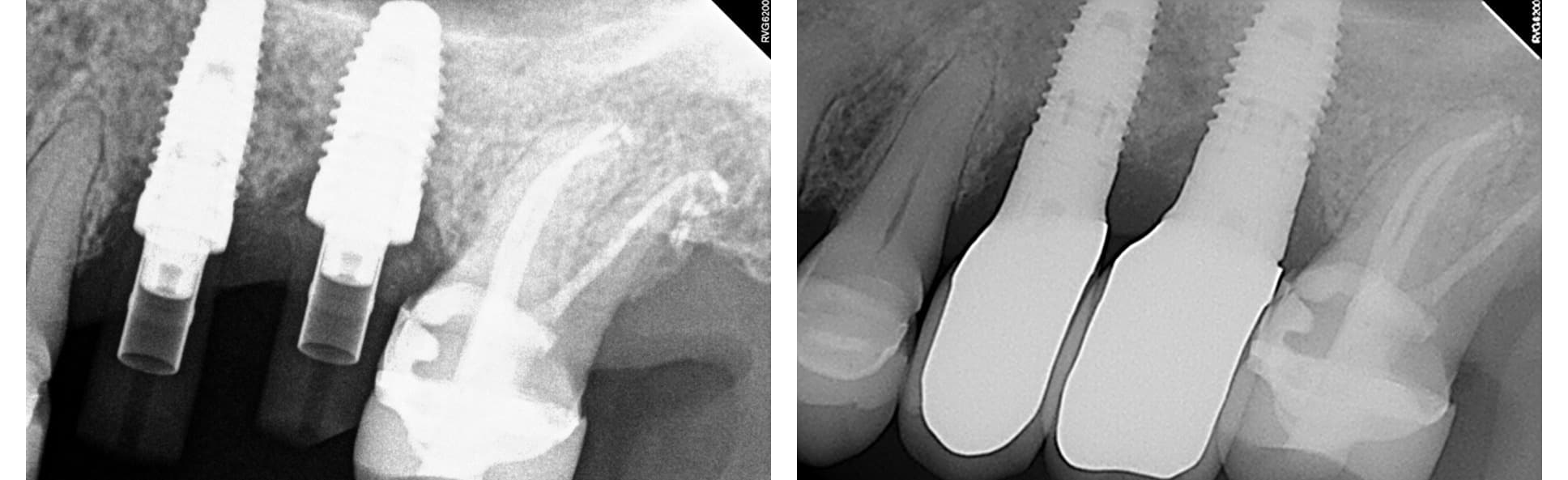 Implant treatment (3 of 3)