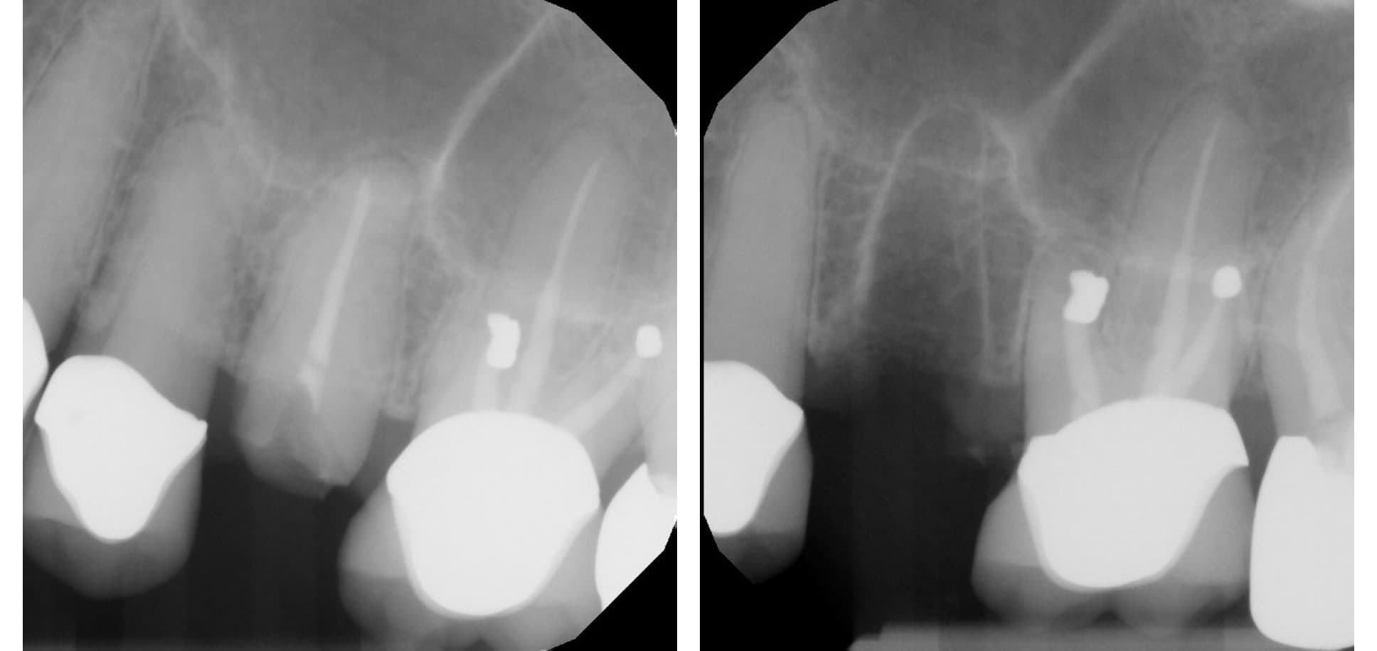 Implant planning (before)