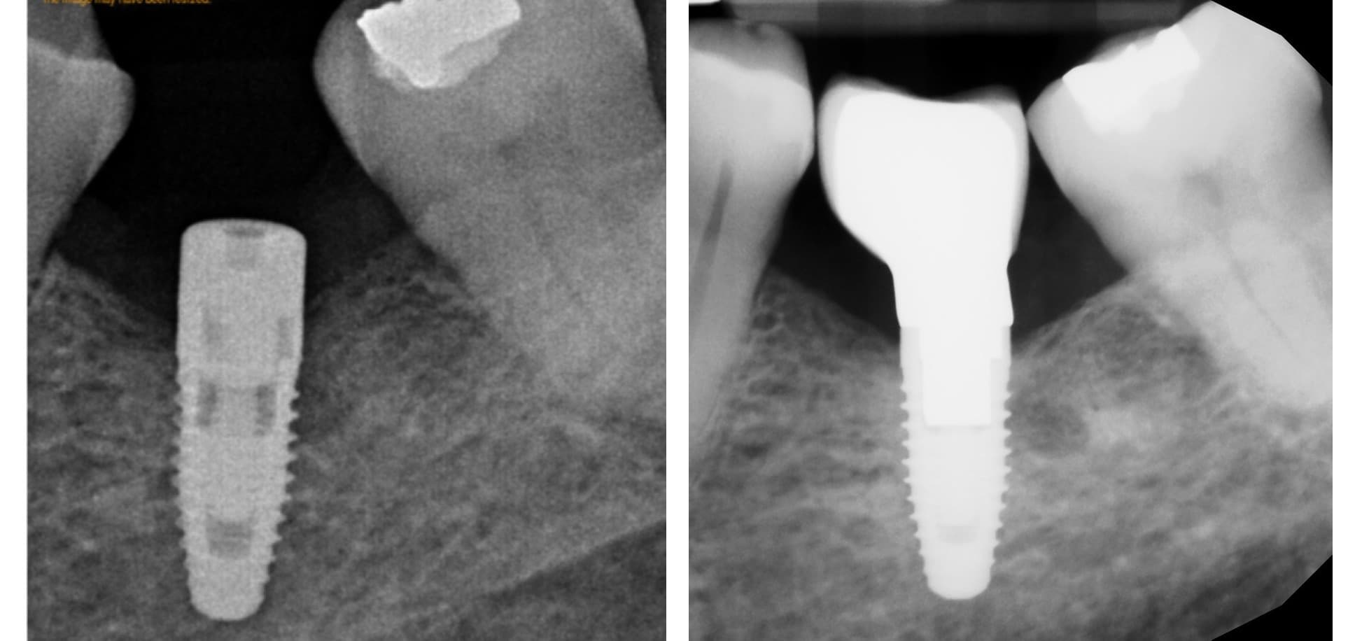 Implant CT planning (after)