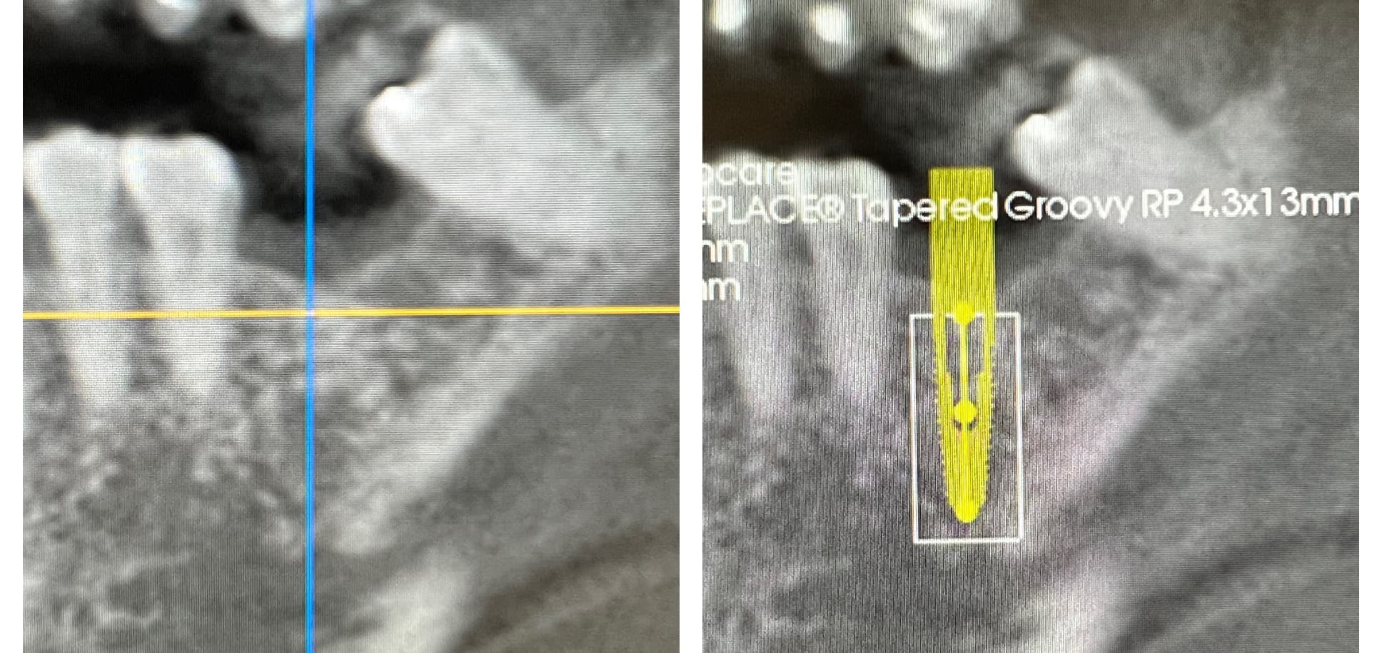 Implant CT planning (before)