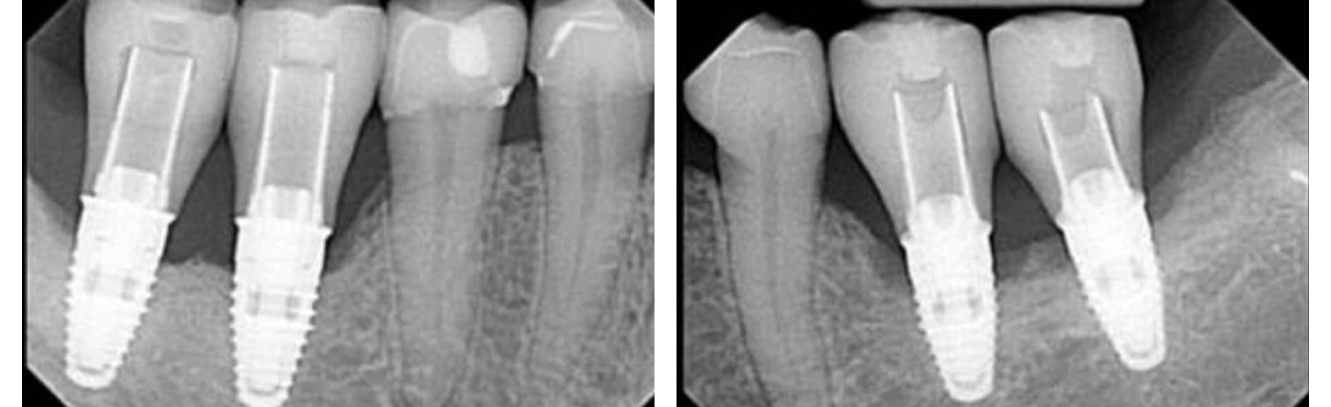 Multi-implant restoration X-rays by Dr. Sharyar Baradaran. Beverly Hills periodontist.