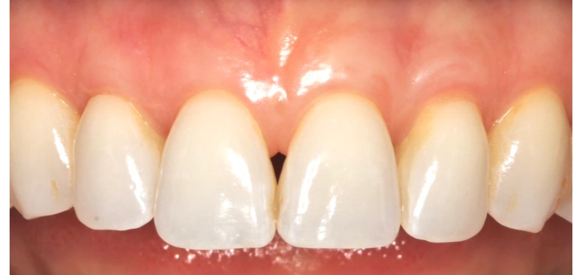 Smile transformation — Beverly Hills (after)