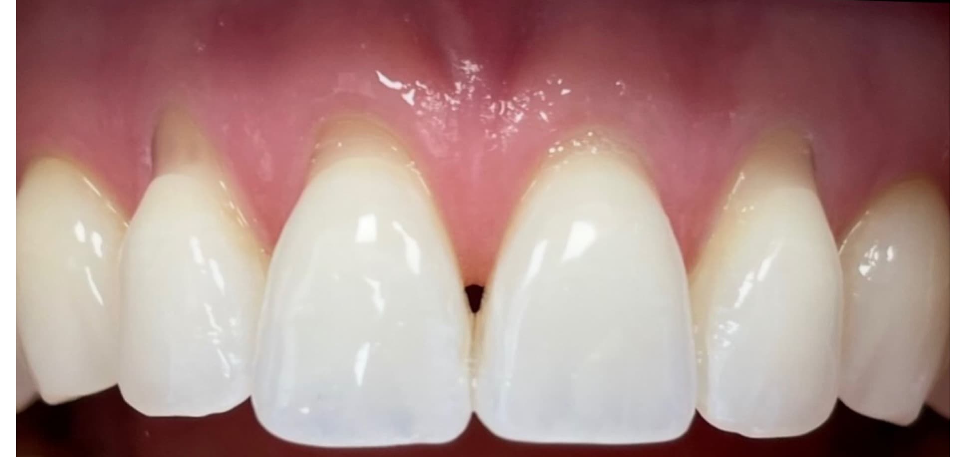 Smile transformation — Beverly Hills (before)