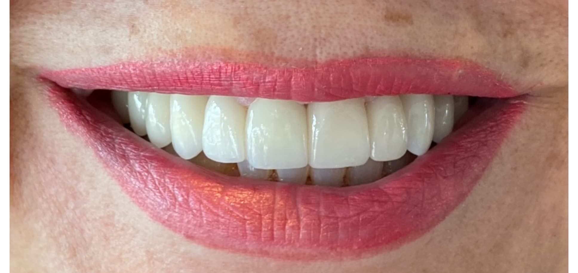 Smile transformation result from Beverly Hills periodontal practice