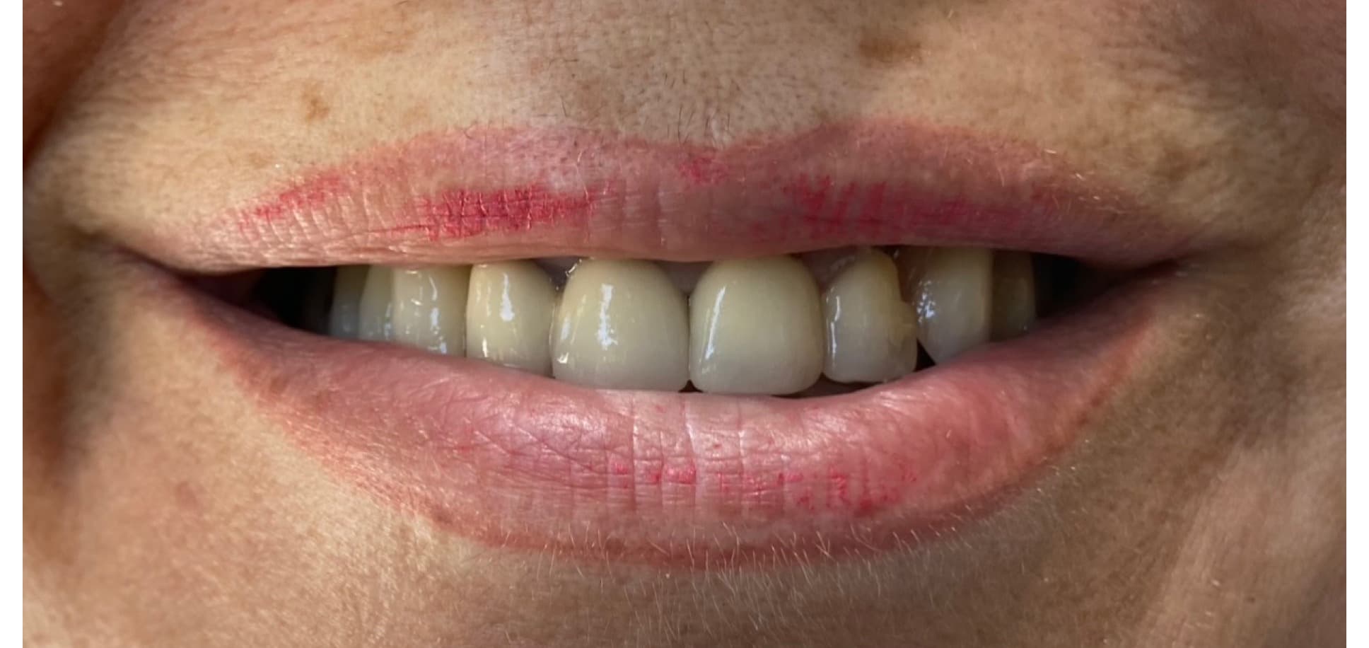 Smile transformation — Beverly Hills (before)